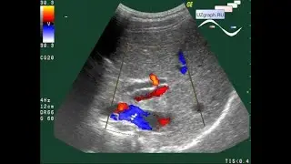 Pediatric Abdominal ultrasound - Double barrel shotgun sign