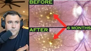 Revolutionizing Eye Health: The Impact of Photobiomodulation on Vision, Ep 1