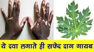 20 साल पुराने सफेद दाग 3 दिनों में ठीक हो गई || leaucoderma treatment ! safed daag ka ilaj