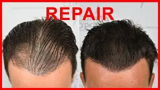 FUE Hair Transplant REPAIR - 2019 grafts Norwood II-III, Dr Bruno Pinto, www.Clinica OPorto.es