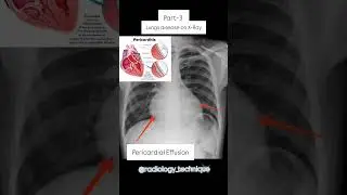 Part -3 Lung disease    #medicalimaging #doctor #reels #medical #anatomy #radiography #xray #hosp