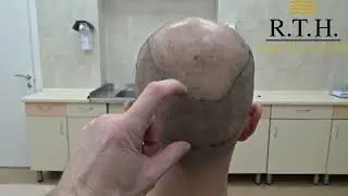 Первый шаг пересадки волос &mdash; оценка донорской зоны