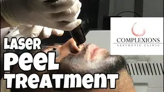 FEELING FRESH | Hollywood laser Peel Treatment | RF | Don Baco Vlogs