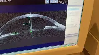 OCT CIRRUS 4000 - ZEISS (2º PARTE)