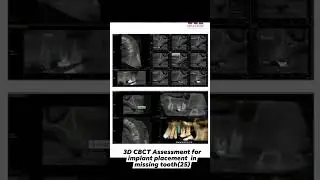 ADVANCED CBCT GUIDED IMPLANTS PLACEMENT.....DR.NIMISH JAIN #facialsurgery  #trending