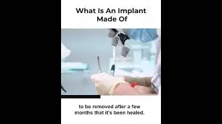What Is An Implant Made Of?