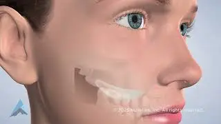 Cheek Implants in Boise and Meridian, ID