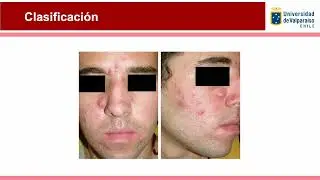 Dermatolog&iacute;a, MEDUVSF 2025: Acn&eacute; y ros&aacute;cea