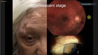 Ocular Manifestations of Systemic Autoimmune Diseases