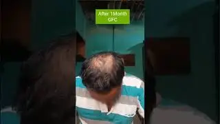 My#GFC Hair treatment #1 Month Result #