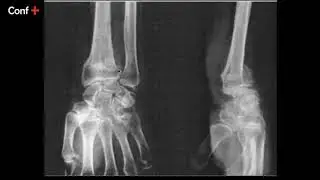 Cas d'imagerie (fracture d&eacute;plac&eacute;e de l&rsquo;extr&eacute;mit&eacute; inf&eacute;rieure du poignet gauche)