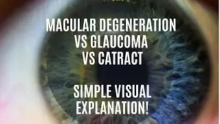 What Does Glaucoma, Macular Degeneration, Cataract, or Diabetes Look Like? A Simple Visual Aid