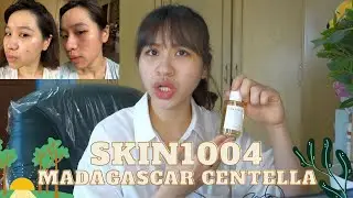 Skin1004 Ampoule Review Indonesia | Skincare Kulit Berjerawat | Cara Menghilangkan Bekas Jerawat