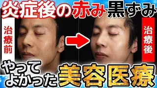 【効果やいかに…！】アトピーの赤み・色素沈着はIPLとpicoレーザー治療でどこまで解決する？