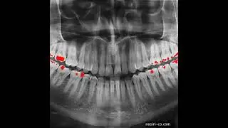#Image #segmentation::#teeth #radiogeraphy::#Amalgam #localization  تصوير و دندانپزشکي (1)