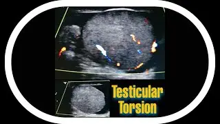 🆕Testicular Torsion🚨Spontaneous Detorsion🆕