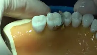＃NTUD ODLab 2025 Tooth 16 MB+MP onlay demo by Dr. 吳總進