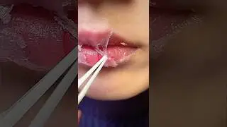 Peeling and dry lips try this home remedy #drylips #chappedlips #virallipcare
