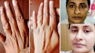 Winter Hand Care Tips | Haathon ki dekhbhal kaise karein | Glow with छोटी si Rasoi