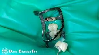 Изоляция зуба с поддесневым уступом при помощи B5 и K-file 20 и PTFE ленты DET.expert & Sanctuary 4K