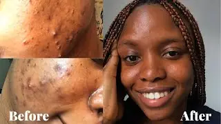 How i cleared the worst Acne of My Life: Acne org review
