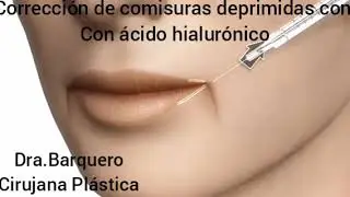 Comisuras deprimidas. Correcci&oacute;n con &aacute;cido hialur&oacute;nico. Dra. Vanesa Barquero. Cirujana Pl&aacute;stica.