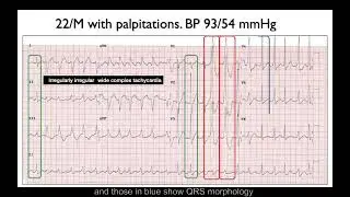 ECG in 60s - Irregularly irregular wide complex tachycardia