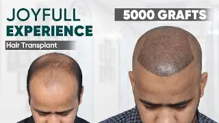 Hair Transplant in Hyderabad (HX-KITE) | Best Results & Cost of Hair Transplant in Hyderabad