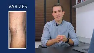 Qual o MELHOR tratamento para VARIZES? Existe?