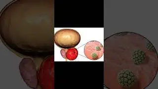 Prostate Cancer Explained &mdash; Tumor Growth Inside the Gland