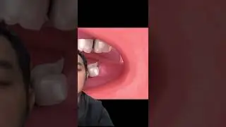 Gigi bungsu tidak harus dicabut kok