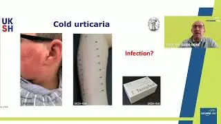 UCARE 4U Patient Webinar 12_Part 2: Pathophysiology of Urticaria