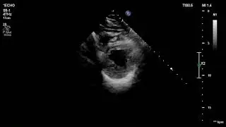 [Echo Case Review]Moderate to severe AR 중증도 대동맥판 역류