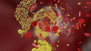 Mayo Clinic Minute - Strategies to reduce diabetes and heart disease