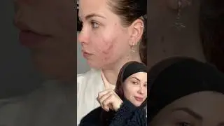 Je regrette d&rsquo;avoir pris Roaccutane ? 😕