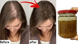 The Indian Secret 🌱 Hair grows like crazy and does not fall out, treats baldness,