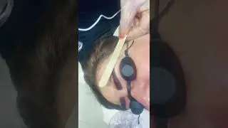 Brow correction with laser