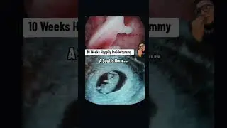10 Weeks happily playing inside Womb #10weeks #10weekspregnant #baby #pregnancyscan