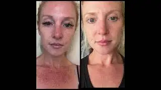 New Skin befor and after