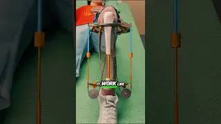 How Doctors Fix Broken Bones Using Metal Rods and Circular Frames &mdash; Surgery Explained!