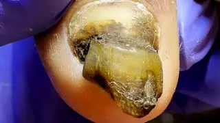Oh My God! Dirty And Thick Onychomycosis【Dr. Liu's Pedicur】