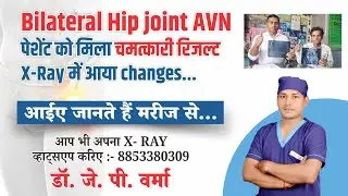 Bilateral Hip Joint AVN मरीज को मिला चमत्कारिक रिजल्ट | X-Ray में दिखे चौंकाने वाले बदलाव
