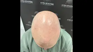 How Do I Prepare My Scalp For Scalp Micropigmentation