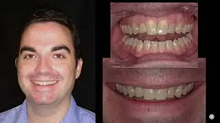 Troubleshooting Teeth Whitening | Solving Common Problems & Improving Outcomes