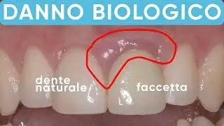 Le faccette dentali che distruggono le gengive | Caso clinico reale