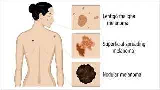 Types of Melanoma ; Superficial Spreading, Nodular, Lentigo Maligna, Acral Lentiginous, Amelanotic