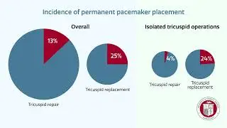 Factors Associated With PPM Placement After TV Operations | Annals Animated (February 2025)