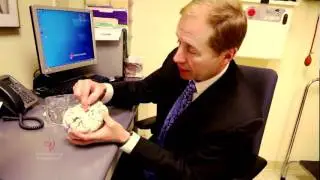 Brain Aneurysm