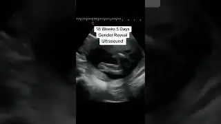 Gender Reveal Ultrasound at 18 Weeks 5 Days Pregnant! Take your guess! #heybabymobile #boyorgirl