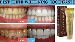 Best Teeth Whitening Products 2019 For Men \& Women